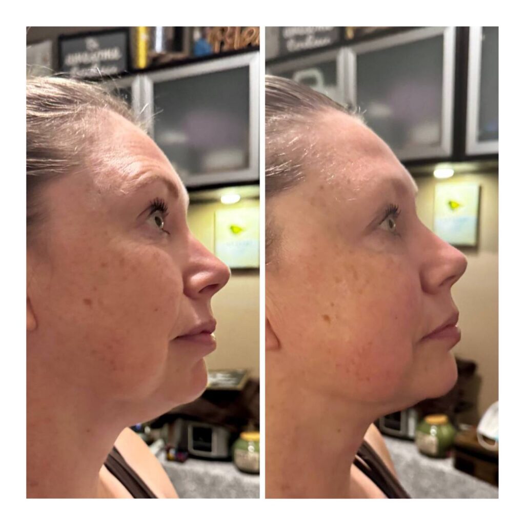A woman before and after an Eleva Method Buccal Massage Treatment